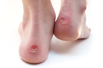 blisters