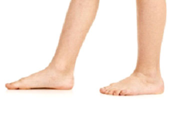 pediatric flat feet