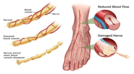 peripheral neuropathy