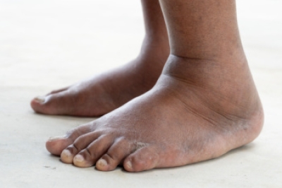 Common Causes of Swollen Ankles and Effective Relief Methods