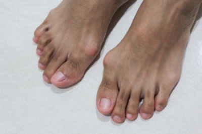 Understanding Bunions